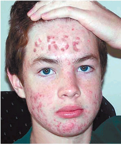 Bummer Dude Teens Acne Spell